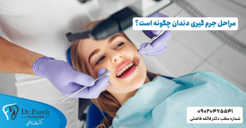 مراحل جرم گیری دندان چگونه است؟