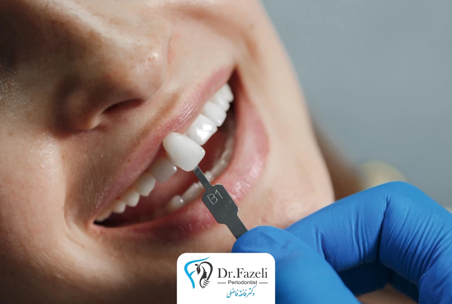 خدمات کامپوزیت دندان