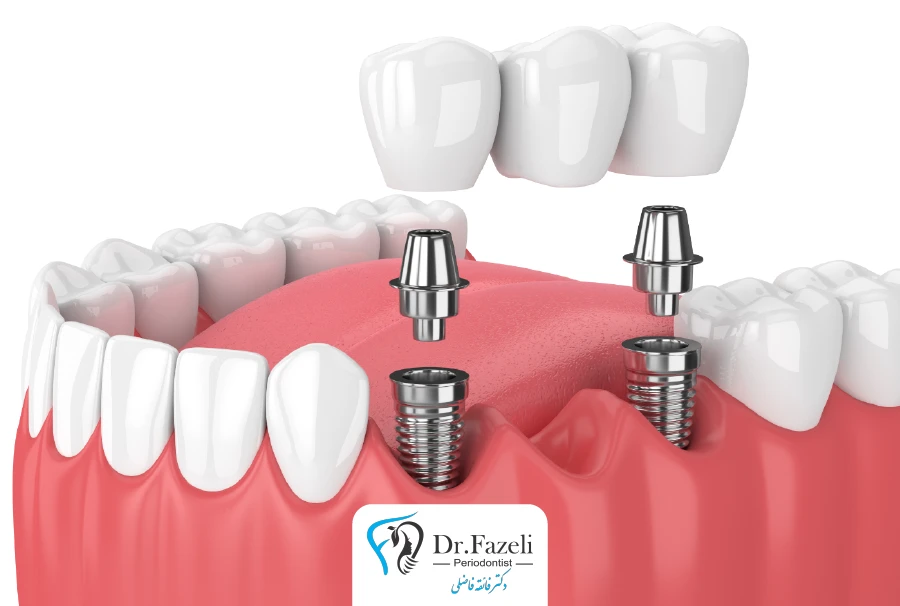 خدمات ایمپلنت دندان