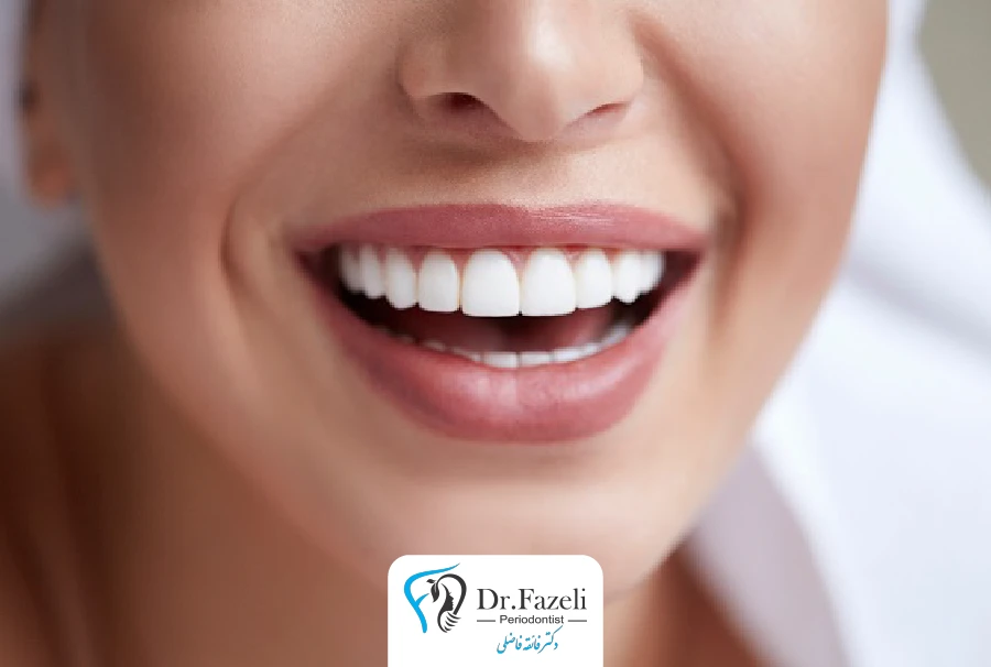 خدمات لمینت دندان