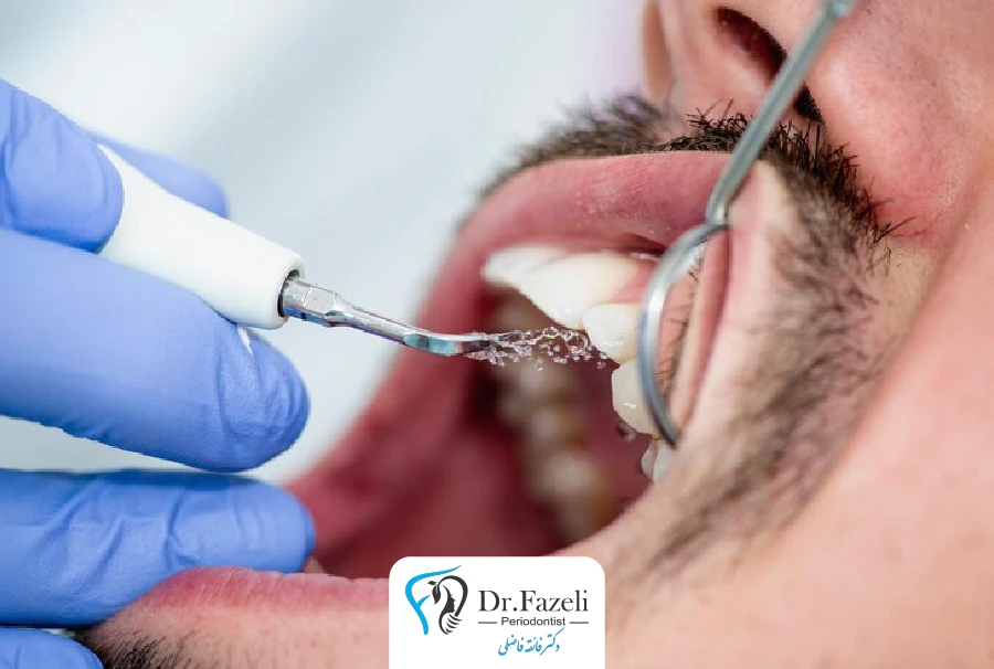 خدمات جرم گیری دندان