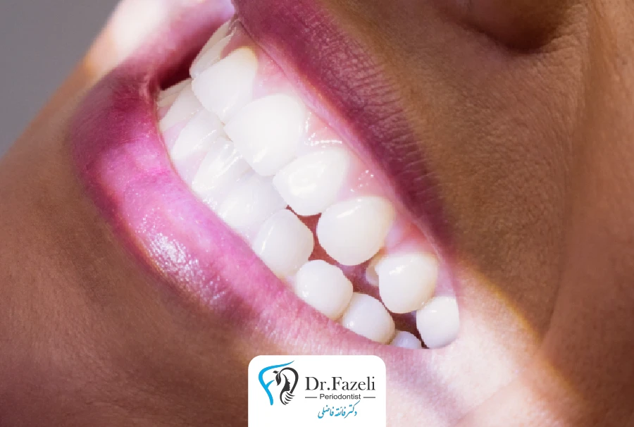 خدمات بلیچینگ دندان