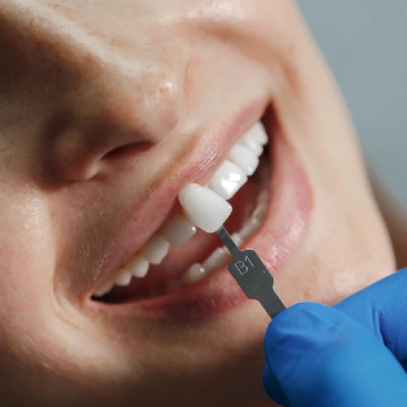 کامپوزیت دندان