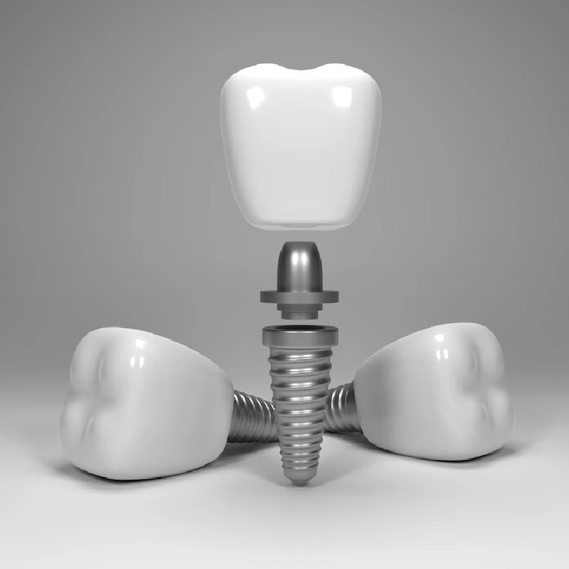 ایمپلنت دندان