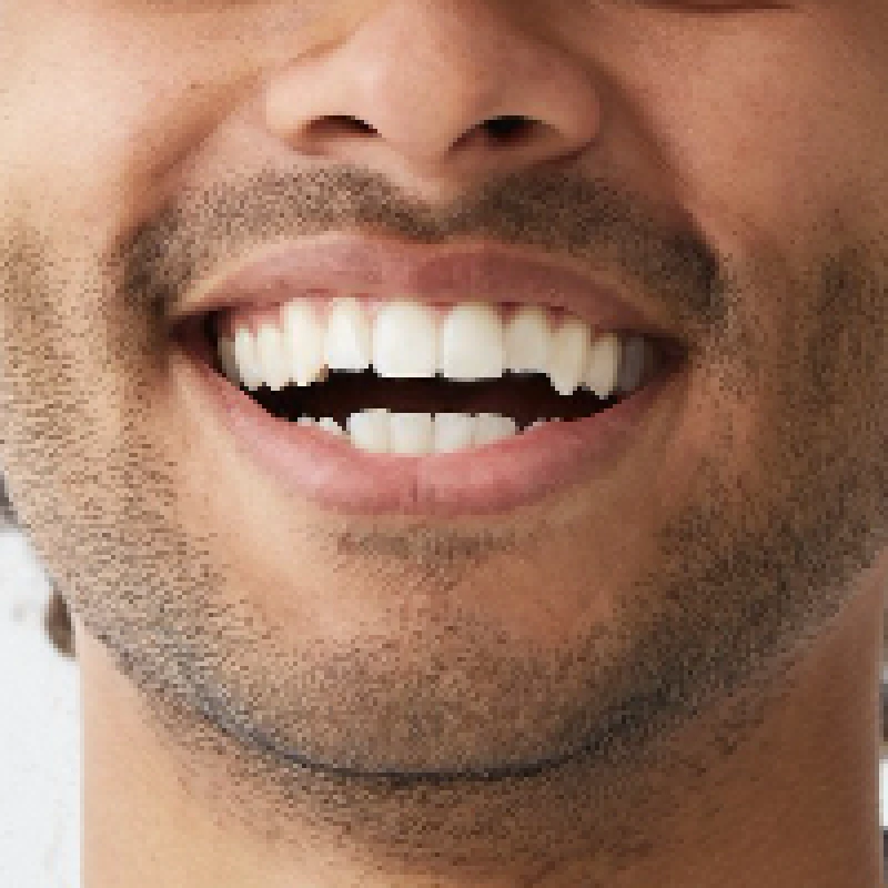 جرم گیری دندان