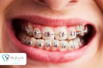 ارتودنسی چیست | معرفی انواع ارتودنسی دندان