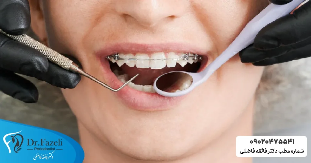 قیمت ارتودنسی دندان در تهران